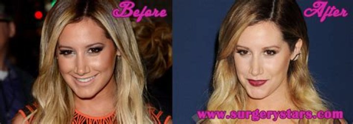 Ashley Tisdale Plastic Surgery Before and After