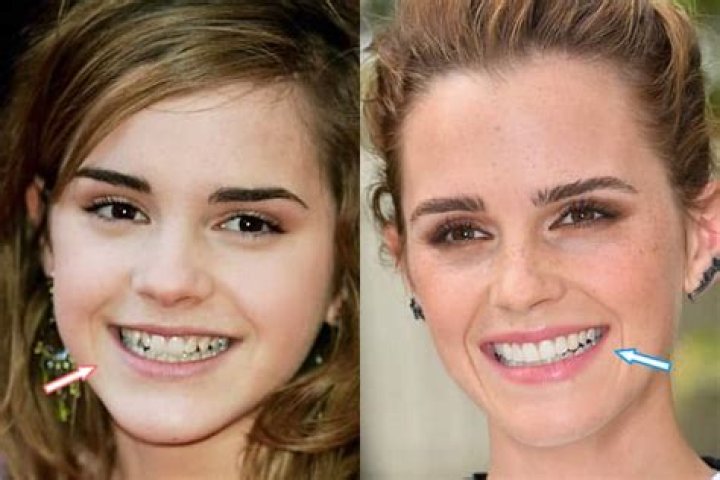 Emma Watson Plastic Surgery Before and After