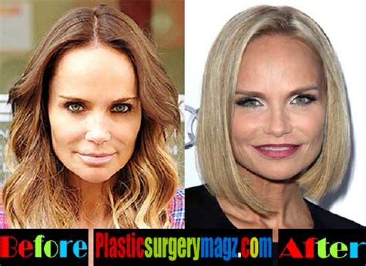 Kristin Chenoweth Plastic Surgery Before and After Botox Injections