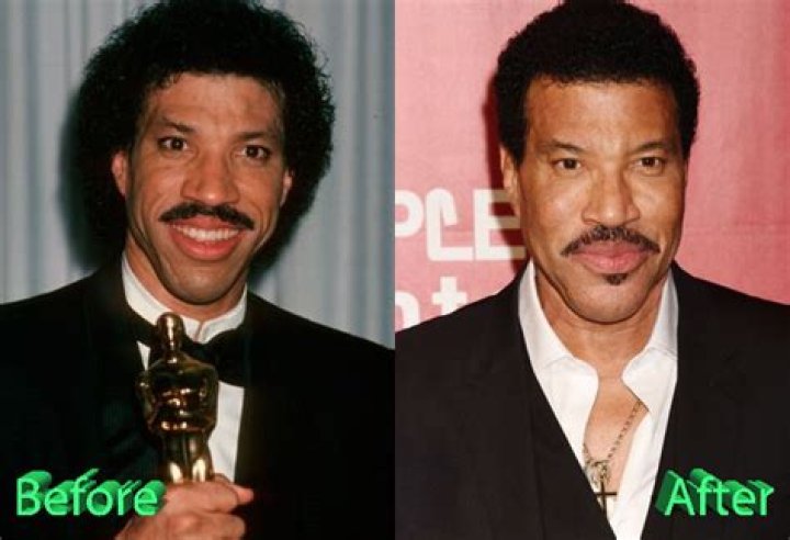 lionel richie plastic surgery