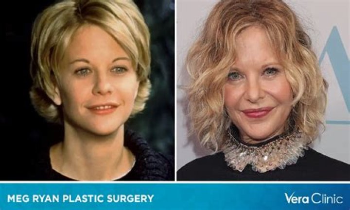 Meg Ryan Plastic Surgery Before and After